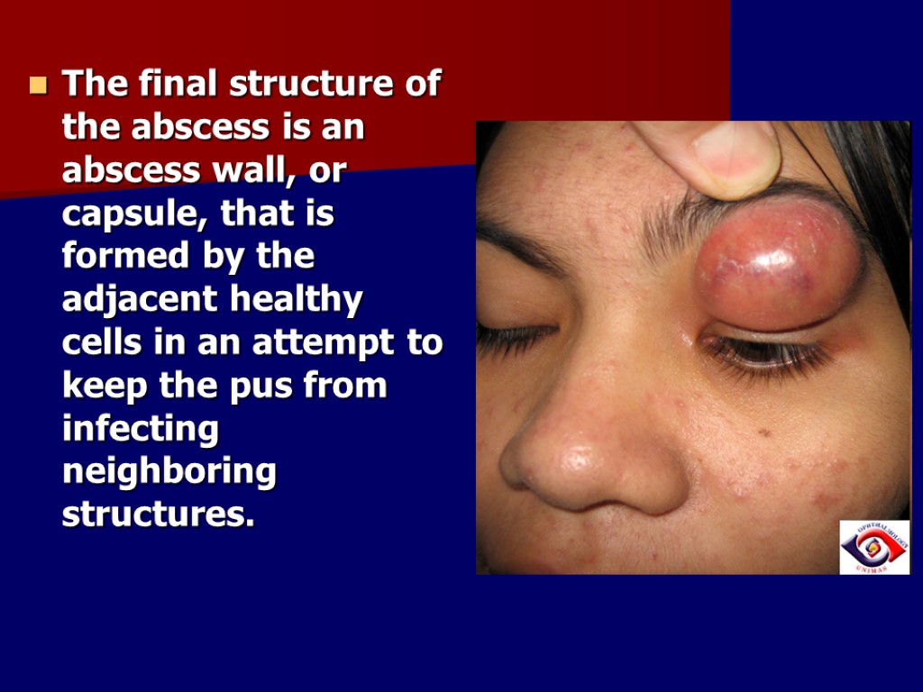 The final structure of the abscess is an abscess wall, or capsule, that is